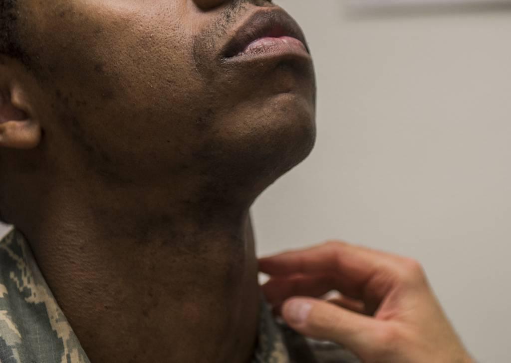The Air Force is now allowing airmen with pseudofolliculitis barbae, a condition causing razor bumps and painful ingrown beard hairs that commonly affects Black men, to ask for a five-year medical shaving waiver instead of Racist text spurs Air Force investigation into alleged squadron job discrimination